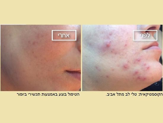 לפני ואחרי טיפול קוסמטיקאית צילום: טלי לב לפני ואחרי טיפול קוסמטיקאית צילום: טלי לב