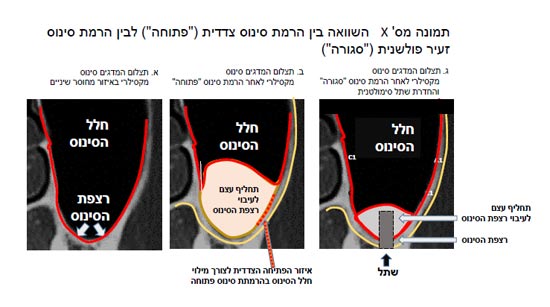 השוואה בין הרמת סינוס צדדית לבין הרמת סינוס זעיר פולשנית / צילום: פרופ' חיים טל השוואה בין הרמת סינוס צדדית לבין הרמת סינוס זעיר פולשנית / צילום: פרופ' חיים טל