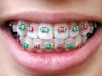 יישור שיניים / צילום: שאטרסטוק