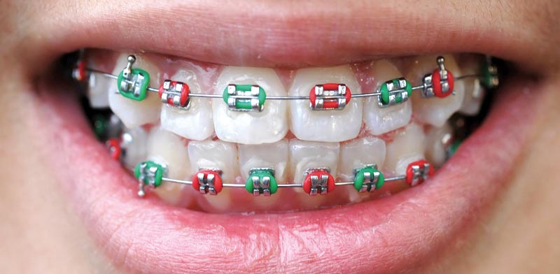 יישור שיניים / צילום: שאטרסטוק