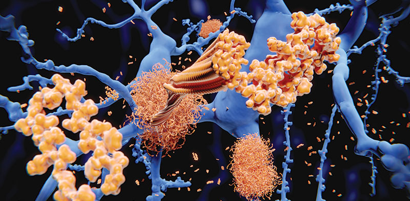 הצטברות של חלבוני עמילואיד בטא, שנקשרת במחלת האלצהיימר / צילום: shutterstock, שאטרסטוק